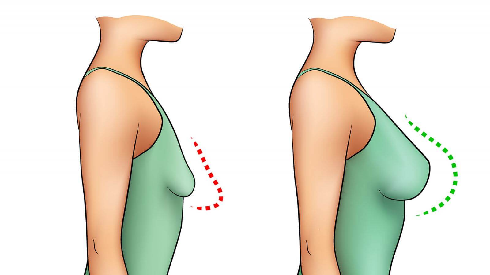 Тубулярную грудь можно исправить только с помощью комплекса «увеличение+ подтяжка»