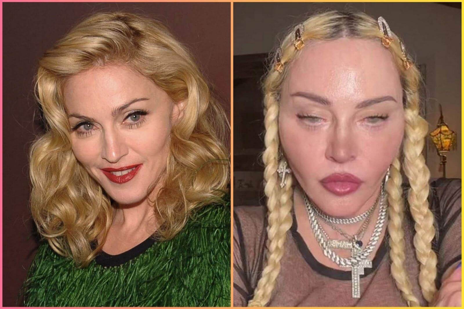 Мадонна до и после пластики