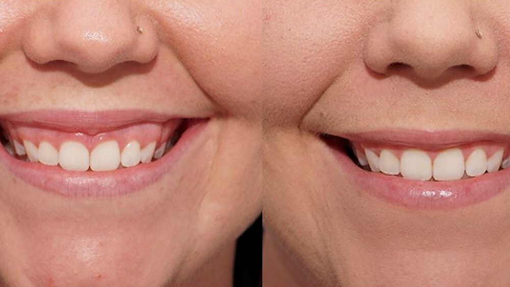 Пластика уздечки верхней губы делает улыбку более привлекательной за счет того, что губа закрывает десну