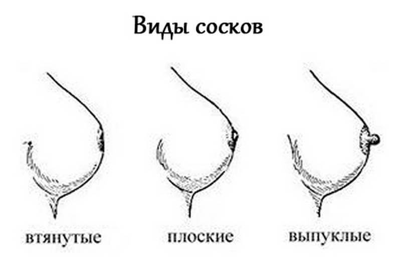 Деформация молочной железы, втяжение соска