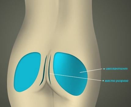 Как проходит глютеопластика