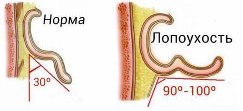 Степени лопоухости