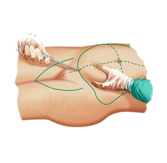 Эндоскопическая абдоминопластика