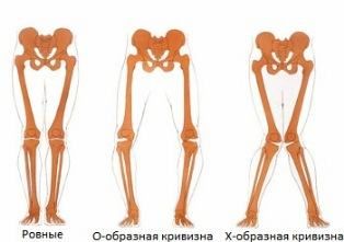 Противопоказания 