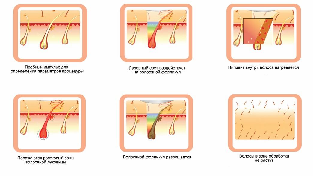 Принцип действия лазерной эпиляции
