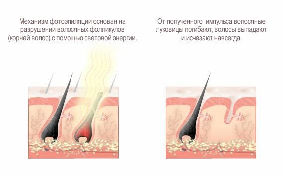 Принцип действия фотоэпиляции