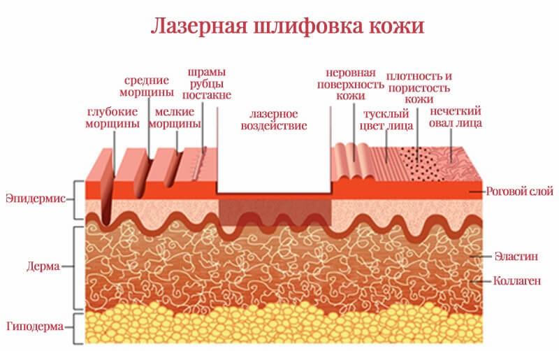 Лазерная шлифовка кожи