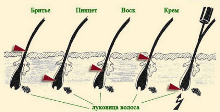 Эпиляци я и депиляция. В чем разница.