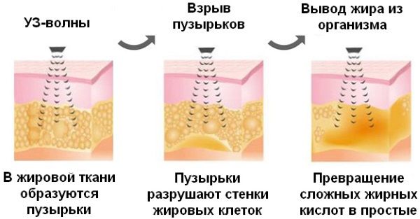 Принцип работы кавитационного аппарата