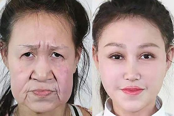 15-летней девочке с лицом «бабушки» сделали пластику