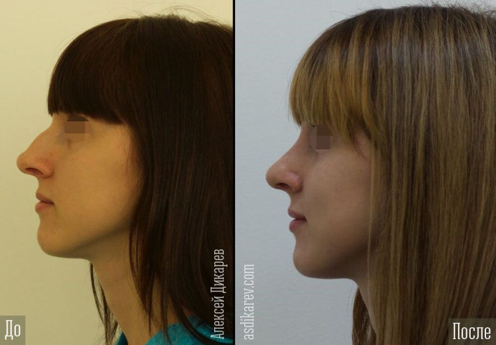 Прически для лица с длинным носом фото до и после