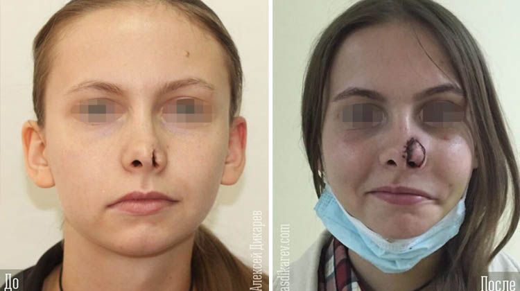 Результаты реконструкции наружного носа, пластический хирург Дикарев Алексей Сергеевич