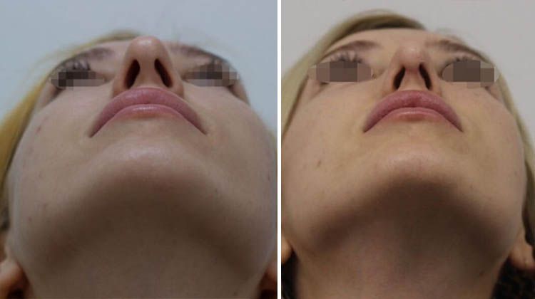 Сужение носа ботоксом до и после фото
