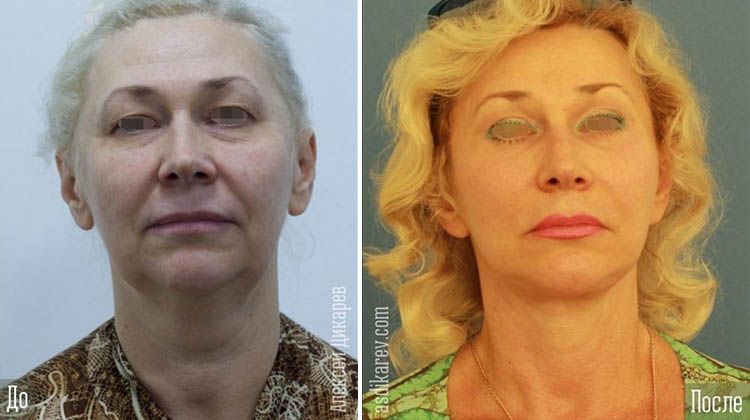 Результаты пациентки до и после тотального фейслифта, пластический хирург Дикарев Алексей Сергеевич