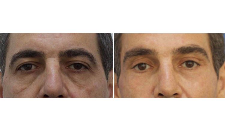 Фото пациента до и после периорбитальное омоложение, пластический хирург Дикарев Алексей Сергеевич