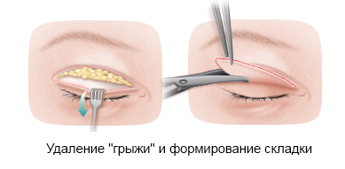 блефаропластики: удаление "грыжи" и формирование складки