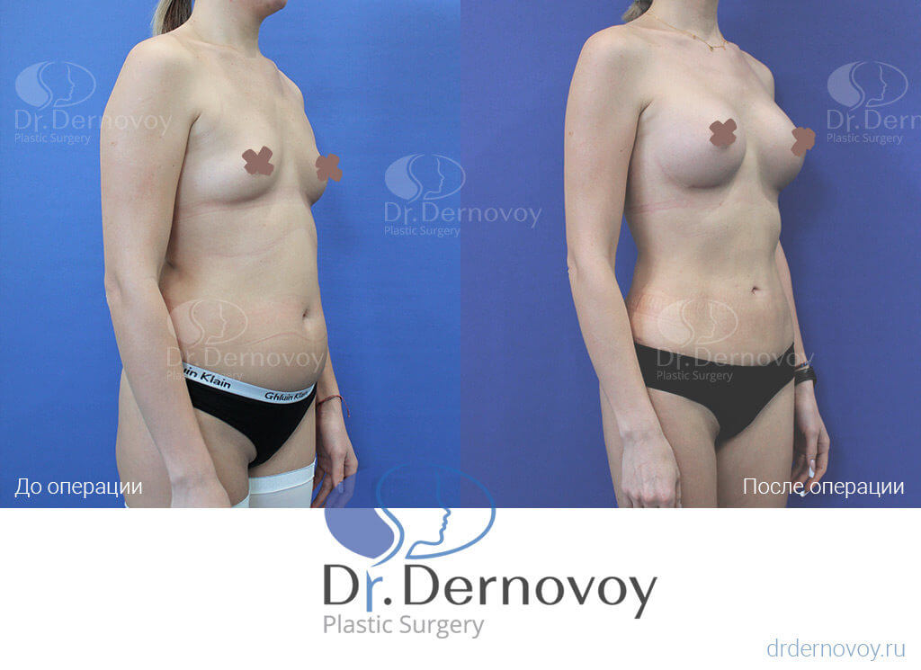 Фото до и споле увеличения груди