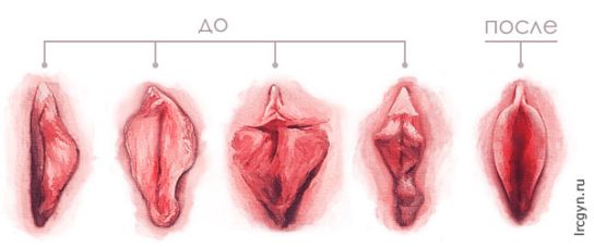 Результат лабиопластики