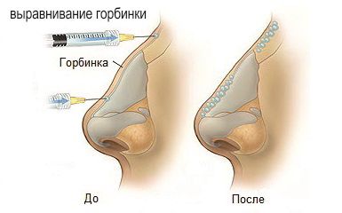 Как исправить нос без операции