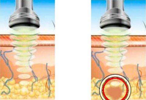 Ультразвуковой метод (кавитация) 