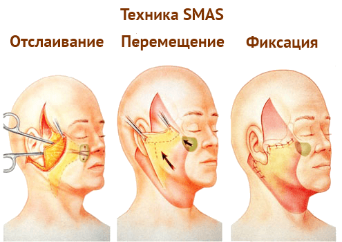 Smas-лифтинг