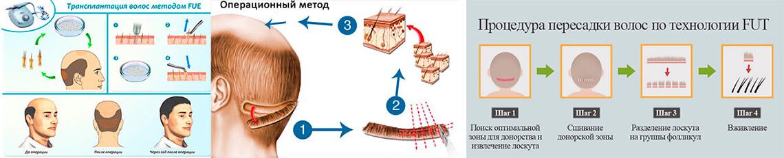 Предлагать способ пересадки. Пересадка волос схема. Технология пересадки волос. Пересадка волос бесшовным методом. Стрип метод трансплантации волос.