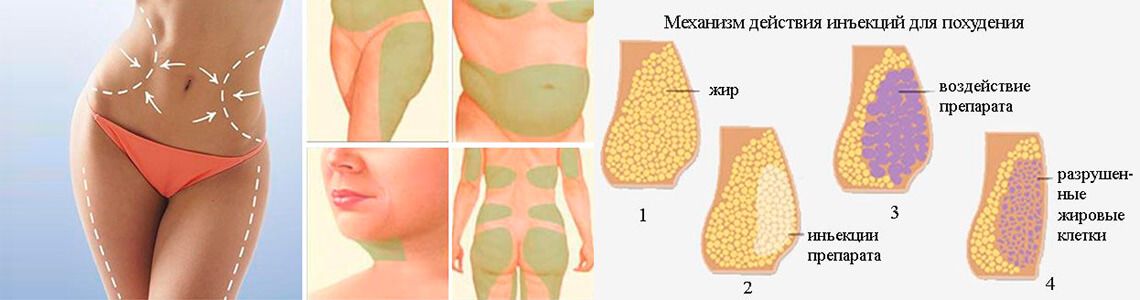 Как быстро начинает действовать. Подкожное Введение липолитиков. Липолитики схема уколов. Схема введения липолитиков в живот. Липолитики в живот схема.