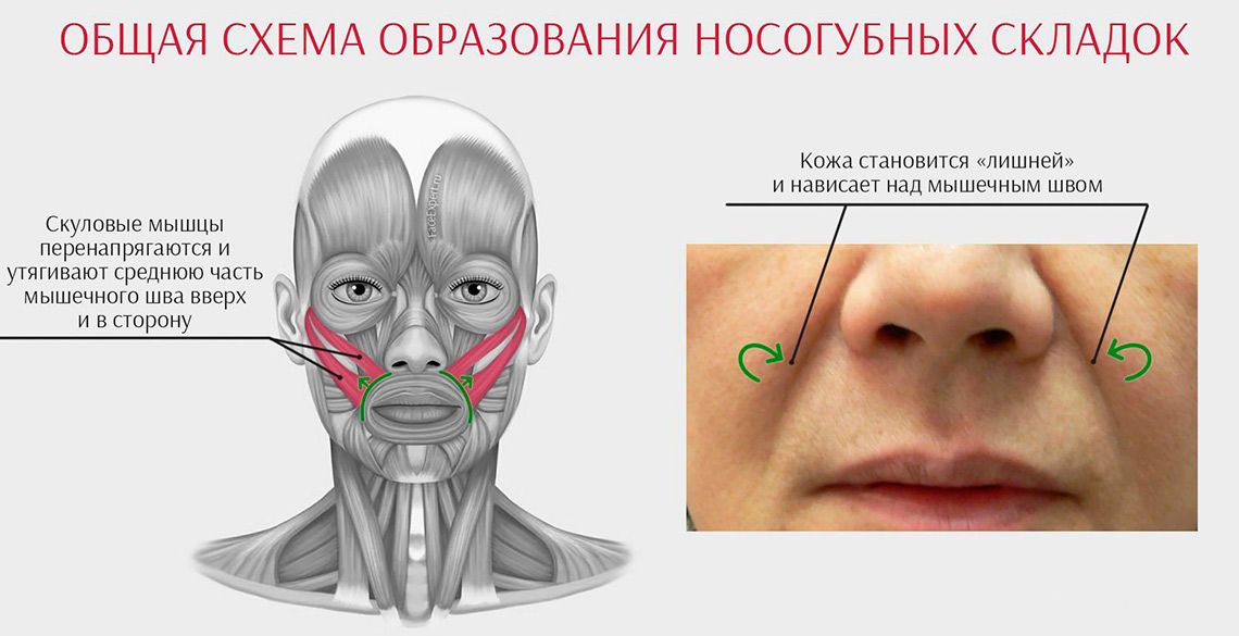 Общая схема образования носогубных складок