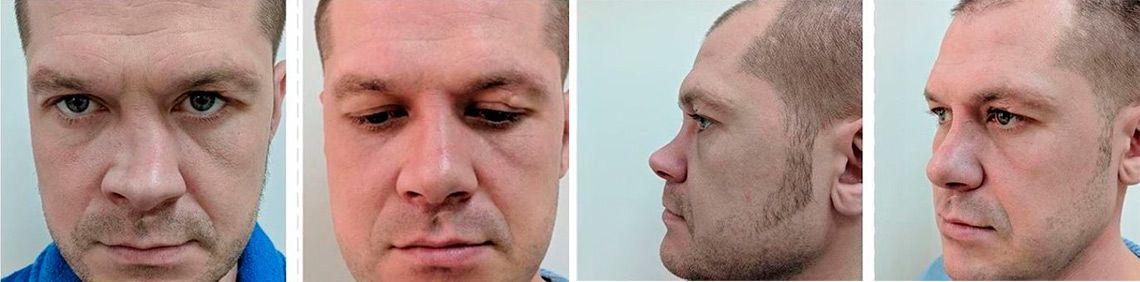 Лазарев нос поправила. Ринопластика до и после мужчины.