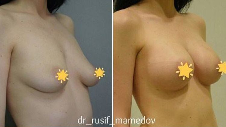 Результаты эндопротезирования груди имплантатами компании Ментор объемом 300 мл, пластический хирург Мамедов Русиф Бежанович