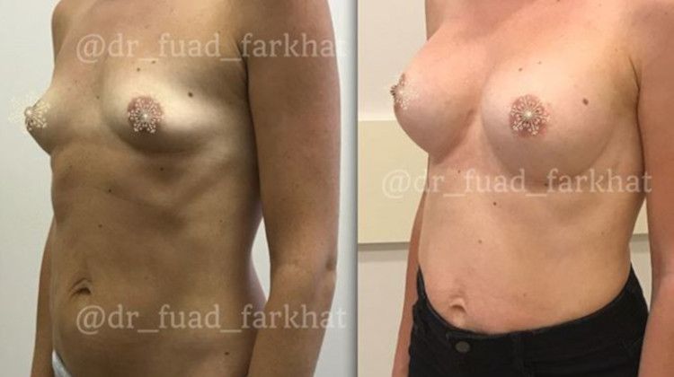 Результаты после увеличения груди с подтяжкой, пластический хирург Фархат Фуад Ахмедович