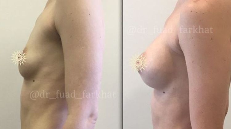 Результаты после увеличения груди, пластический хирург Фархат Фуад Ахмедович