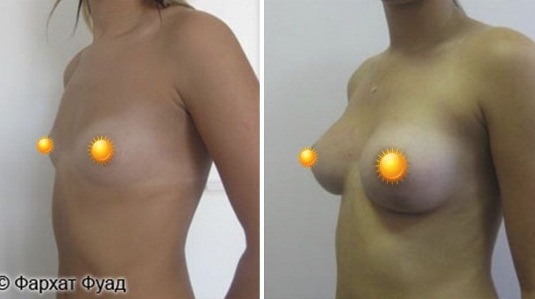 Результаты операции эндопротезирования груди имплантатами объемом 290 мл, пациентка 24 года, пластический хирург Фархат Фуад Ахмедович