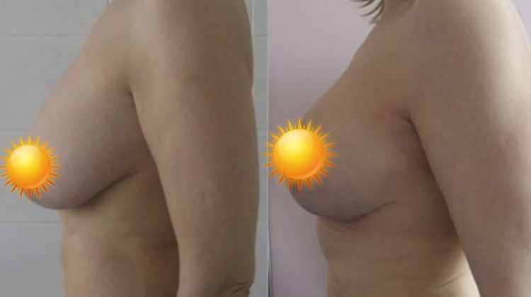 Операция по уменьшению груди, женщина 35 лет, пластический хирург Фархат Фуад Ахмедович