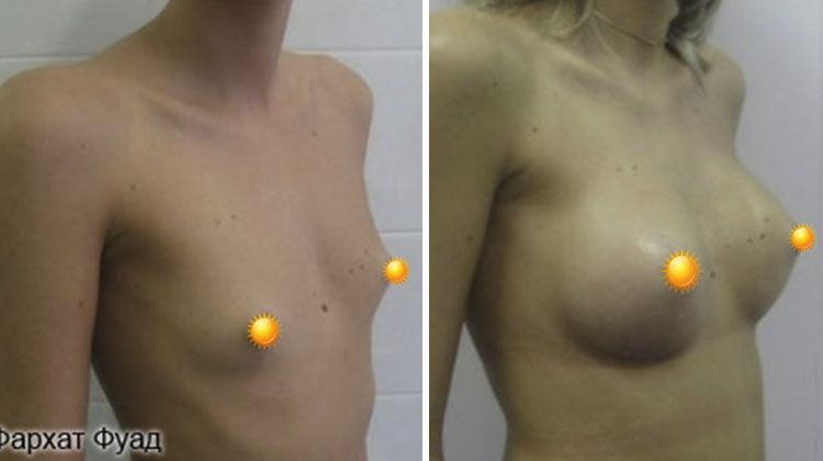 Результаты после операции по увеличению груди имплантатами с объемом 320 мл, пациентка 30 лет, пластический хирург Фархат Фуад Ахмедович