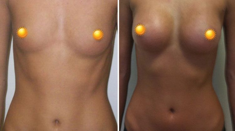 Операция по увеличению груди у нерожавшей девушки каплевидными имплантатами объемом 350 мл, пластический хирург Фархат Фуад Ахмедович