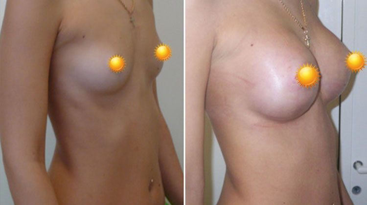 Операция по увеличению груди с использованием анатомических имплантатов, нерожавшая пациентка, пластический хирург Фархат Фуад Ахмедович