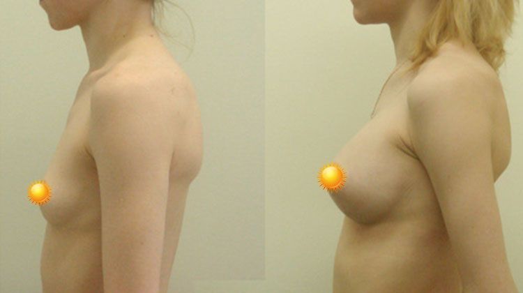 Увеличение груди с использованием каплевидных имплантатов, пациентка Ирина, 25 лет, пластический хирург Фархат Фуад Ахмедович