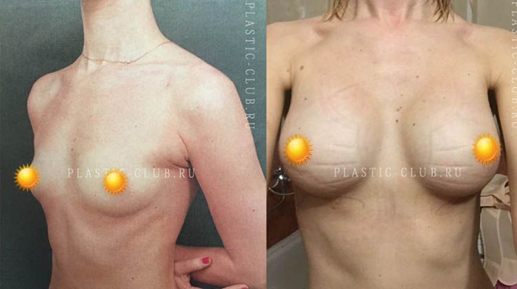 Фотографии пациентки до и после увеличения груди имплантатами Natrelle 320 мл, пластический хирург Фото до и после увеличивающей маммопластики имплантатами Natrelle 320 мл