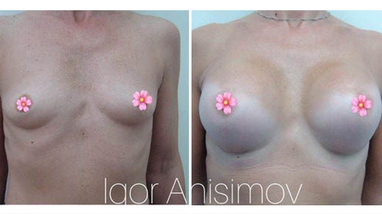 Результаты увеличения объема груди и коррекция ее формы, пластический хирург Анисимов Игорь Дмитриевич