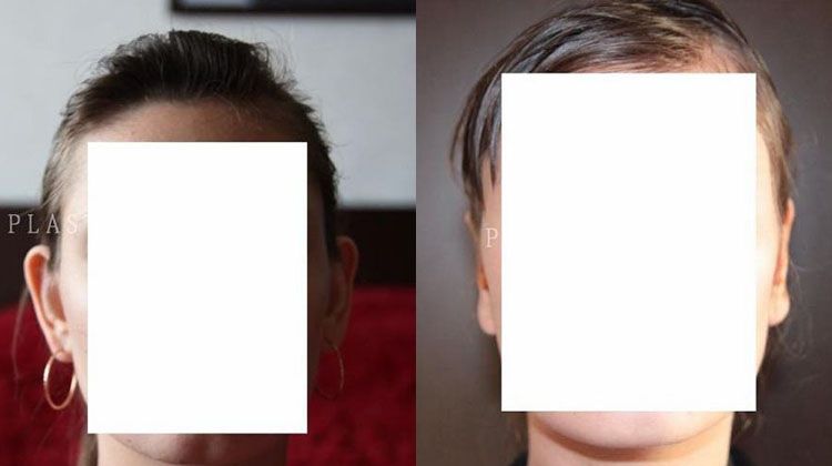 Отчет пациентки после изменения положения ушей с двух сторон, пластический хирург Фото до и после двусторонней отопластики