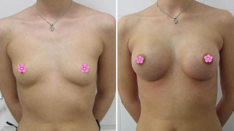 Отзыв пациентки об увеличении груди и коррекции ее формы, пластический хирург Демин Сергей Анатольевич