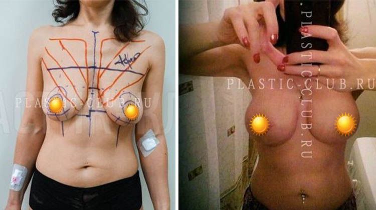 Результаты увеличивающей маммопластики на асимметричной груди, пациентка 41 года, пластический хирург Фархат Фуад Ахмедович