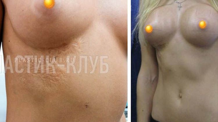 Итоги установки имплантов с ожогом под грудью, пациентка 28 лет, пластический хирург Фархат Фуад Ахмедович