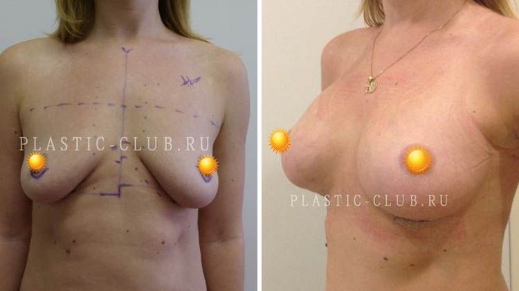 Отзыв с фото пациентки до и после увеличивающей маммопластики на килевидной грудной клетке, пластический хирург Фархат Фуад Ахмедович