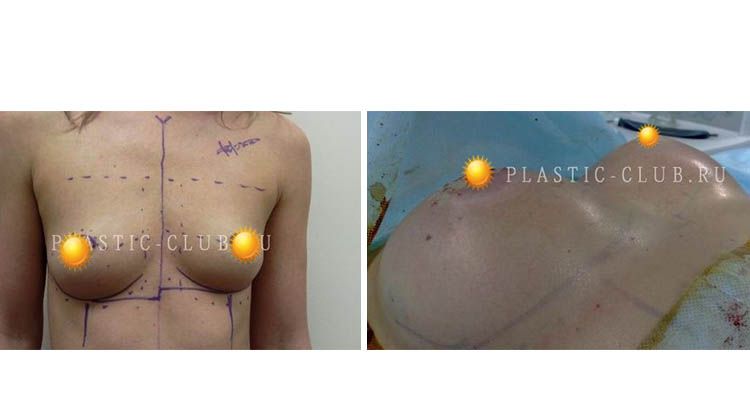 Результаты после увеличения груди с асимметрией, пациентка 30 лет, пластический хирург Фархат Фуад Ахмедович