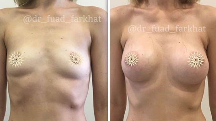 Результаты увеличения груди круглыми имплантатами с установкой под мышцу, пластический хирург Фархат Фуад Ахмедович