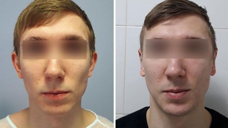 Результаты после операции по коррекции формы ушей с двух сторон, пластический хирург Демин Сергей Анатольевич