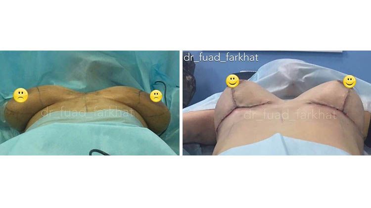 Результаты якорной редукционной маммопластики без использования имплантатов, пластический хирург Фархат Фуад Ахмедович