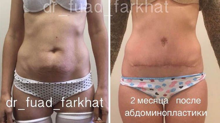 Результаты пациентки, прошедшей пластику живота без переноса пупка, пластический хирург Фархат Фуад Ахмедович